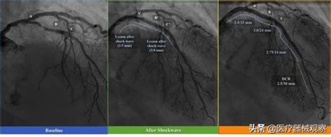 Shockwave在美國開始關於冠狀動脈內血管碎石術的關鍵研究 每日頭條