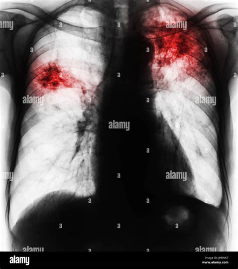 Pulmonary Tuberculosis Film Chest X Ray Show Fibrosis Interstitial