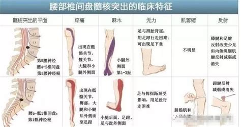 腰間盤突出壓迫神經腿疼該怎麼辦？ 每日頭條