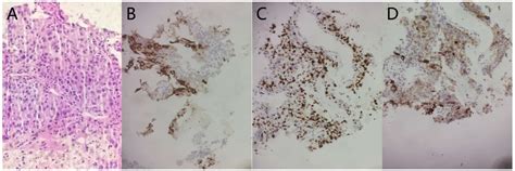 Frontiers Hepatoid Adenocarcinoma Of The Lung With PD L1 Expression