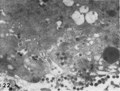 Partially Enveloped Virus In The Golgi Complex Upper And Lower Righlt