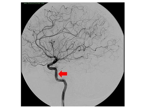 Interventional Neuroradiology: Anatomy of the internal carotid artery (ICA)