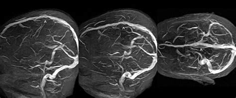 Dr Balaji Anvekar Frcr Sup Sag Sinus Partial Thrombosis