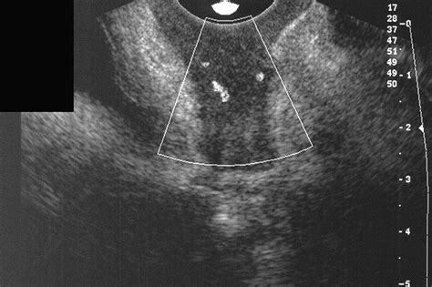 Gray Scale And Color Doppler Sonographic Features Of The Vaginal Cuff