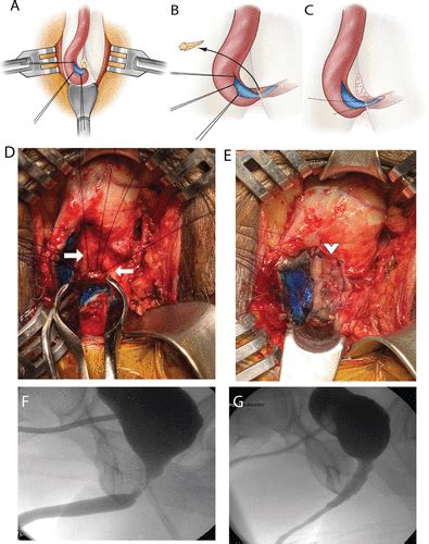 Multi Institutional Outcomes Of Dorsal Onlay Buccal Mucosal Graft