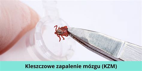 Kleszczowe Zapalenie M Zgu Kzm Objawy Diagnostyka Leczenie