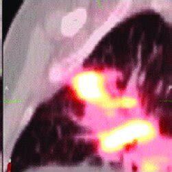 Composite positron emission tomography/computed tomography and computed ... 