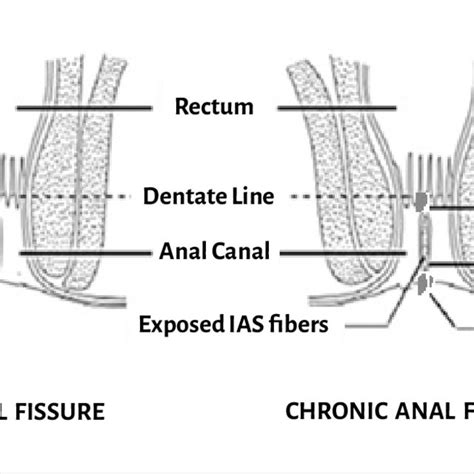 Treatment Options For Anal Fissure Download Scientific Diagram