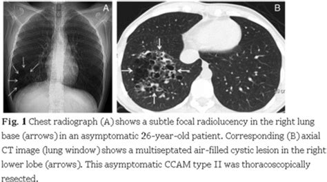 Cystic Adenomatoid Malformation Of The Lung In Adult Patients Clinicoradiological Features And