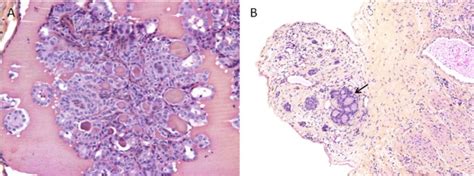 A Microscopic Focus Of Papillary Thyroid Carcinoma In Struma Ovarii