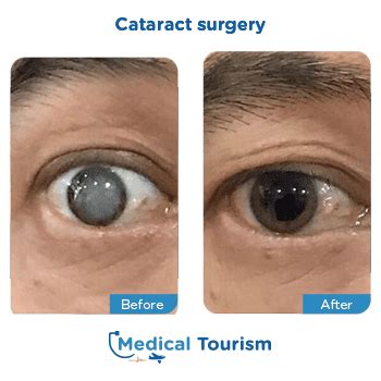 Best Doctors For Cataract Surgery Medical Tourism Mexico