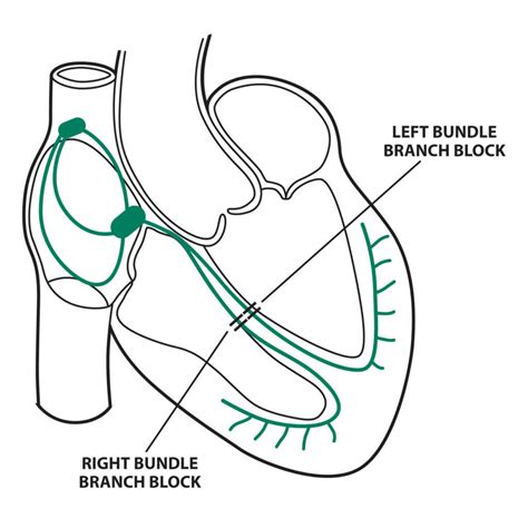 Bundle Branch Blocks (Part 1 – Left and Right Bundle Branch Blocks ...