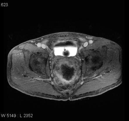 Rectal Cancer Staging Radiology Reference Article Radiopaedia Org