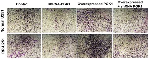 Phosphoglycerate Kinase 1 Promotes Radioresistance In U251 Human Glioma