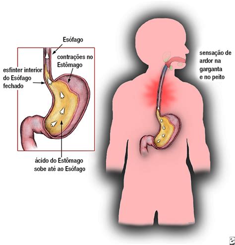 Azia Gastrite E Refluxo Saiba Mais Sobre Esses Problemas