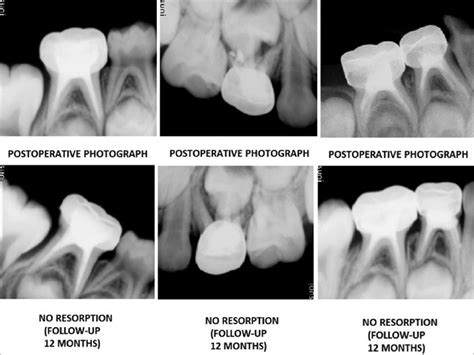 Radiographic Assessment Of Root Resorption After Months In