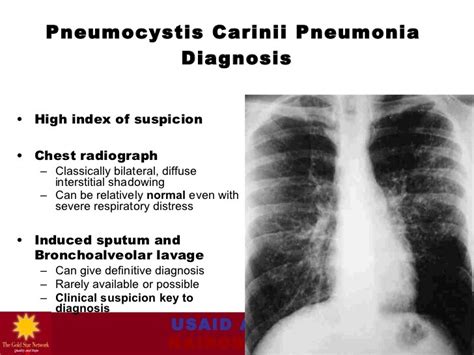 Pneumocystis Carinii Fungal Infections