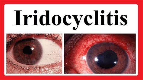 Iridocyclitis Youtube