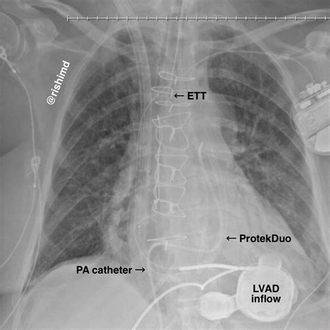 Protekduo Veno Venous Cannula Rk Md