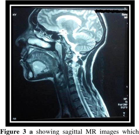 Figure 3 From Arterio Venous Malformation Of Tongue A Case Report