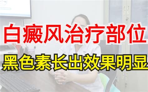 【接诊】白癜风患者治疗部位开始有黑色素细胞，逐渐开始恢复哔哩哔哩bilibili