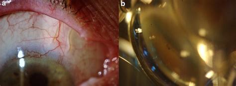 Double XEN45 Gel Stent Implant Subconjunctival A And Gonioscopic