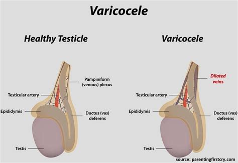 What Is The Link Between Varicocele And Infertility