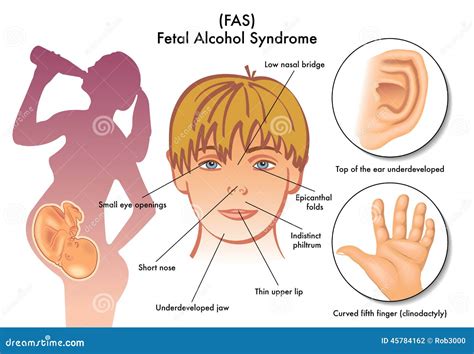 Síndrome Alcohólico Fetal Ilustración del Vector Imagen 45784162