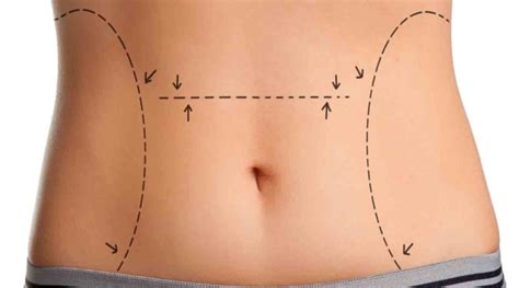 O que você precisa saber antes da cirurgia Ju Rocha Fit