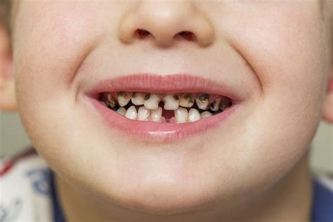 Conoce Los Tipos De Caries Que Existen Simetria Dental