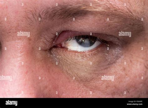 Close up of eye infection with swollen eyelid Stock Photo: 94397366 - Alamy