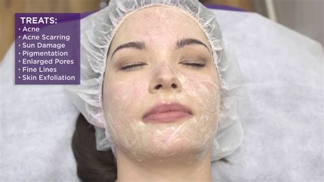 Australian Laser And Skin Clinics Chemical Peels Youtube