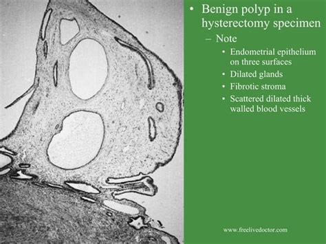 Endometrial polyps