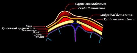 Hawaii Cephalohematoma Attorneys | 40+ Years of Experience