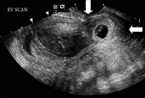 File:Cervical ectopic ultrasound.jpg - Embryology