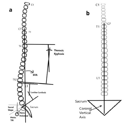 Pdf Effects Of Lumbar Microdiscectomy On Spinopelvic Parameters