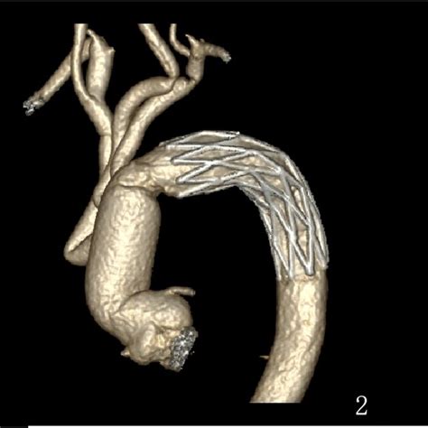 A Preoperative Aortic Ct Angiography Cta Indicates Aortic Download Scientific Diagram