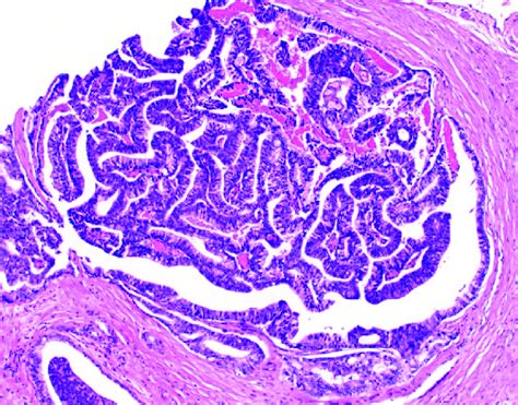 Prostatic Ductal Adenocarcinoma Tall Columnar Cells Line Fibrovascular Download Scientific