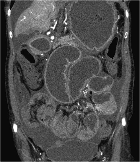 Abdominal And Pelvic Computed Tomography Showing Distended Download Scientific Diagram