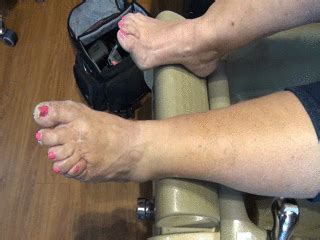 Model Feet Deformed Foot Mature