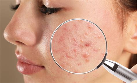 Pele acneica 9 cuidados que são fundamentais para tratamento Acne