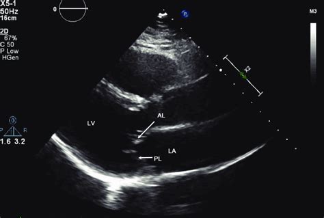 Parasternal Long Axis Ultrasound