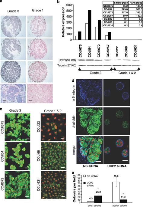 UCP2 Is Differentially Expressed By Primary Breast Cancer Of Varying