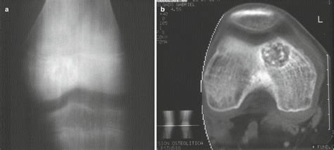 Chondroblastoma Musculoskeletal Key