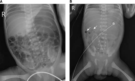 Abdominal X Ray Findings Of The Neonatal Gastric Perforation Before And