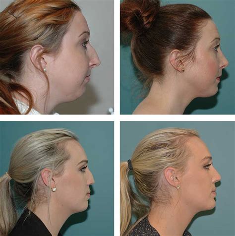 Genioplasty Chin Surgery In Perth — Ethicos Institute