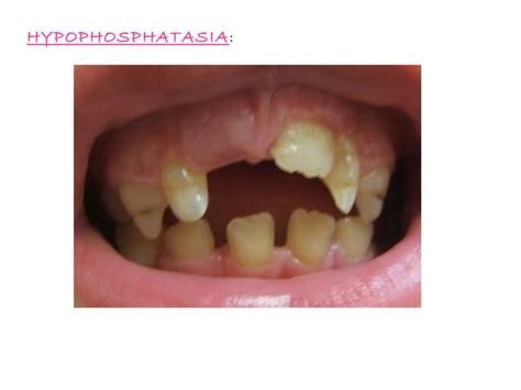 Juvenile Periodontitis