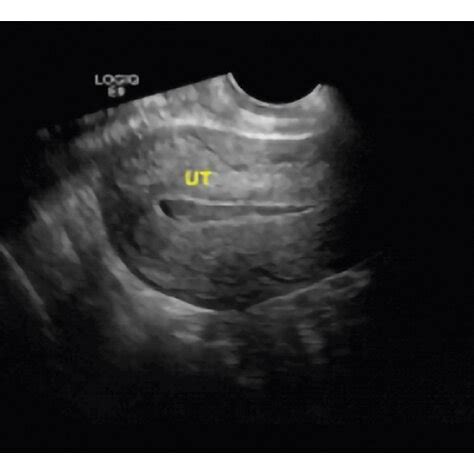 The endometrial line was clear, the thickness of the endometrium was ...