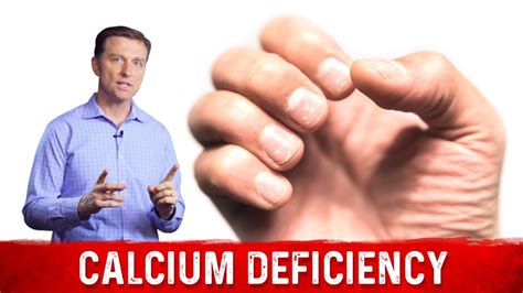 Causes Symptoms Of Calcium Deficiency Dr Berg Youtube