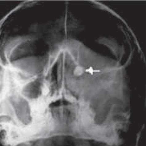 Sinus X Ray Series